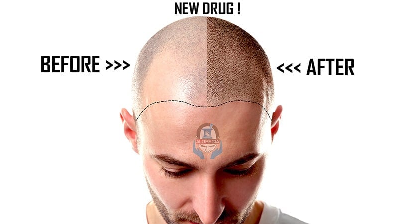 Drug WAY-316606 Latest News on hair loss treatments