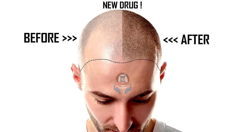 Drug WAY-316606 Latest News on hair loss treatments