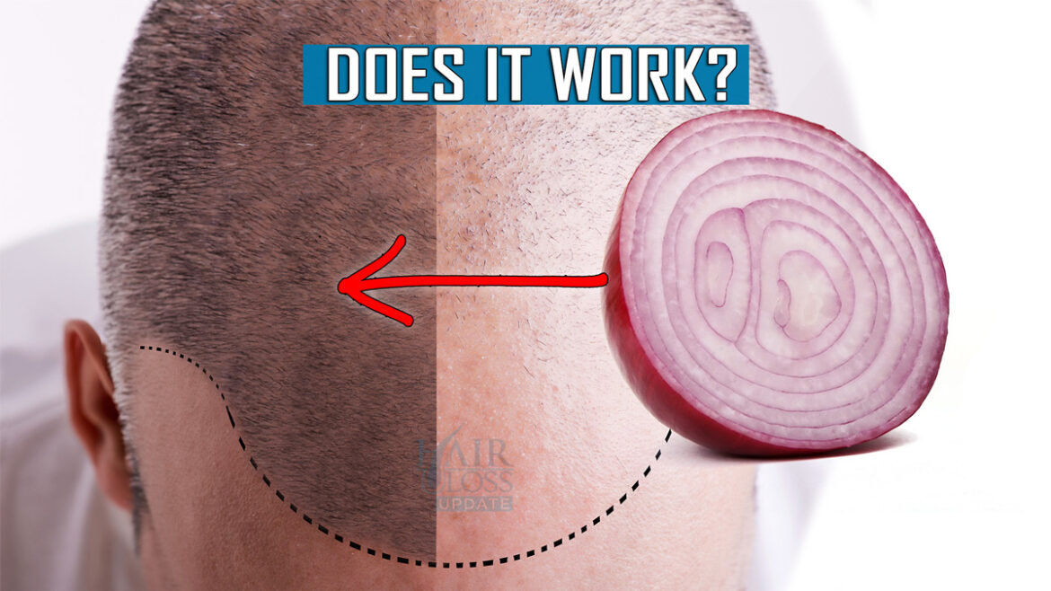 Onion Juice for hair growth