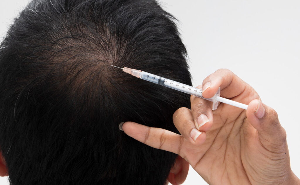 PRP hair loss treatment works