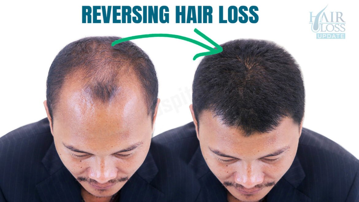 Reversing Your Hair Loss Stage-wise Using Norwood Scale