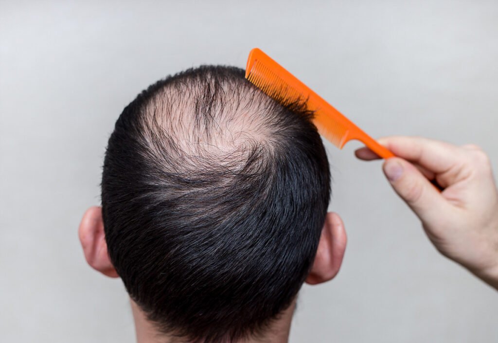 hair loss questions answered