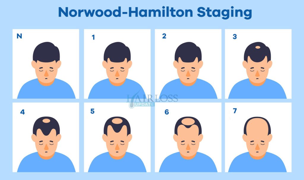 norwood hamilton hair loss staging illustrated