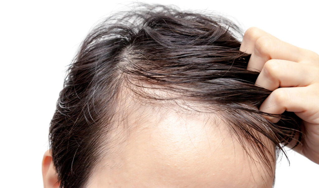 prp androgenic alopecia
