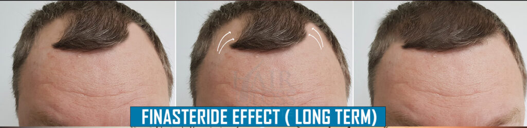 Finasteride propecia - before after evidence