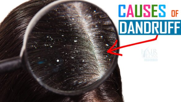 Understanding Dandruff and Causes of Dandruff Flakes