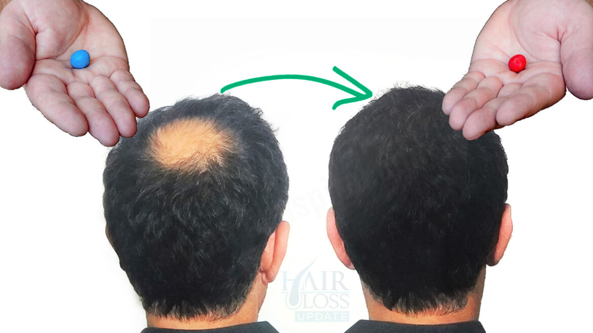finasteride for hair loss