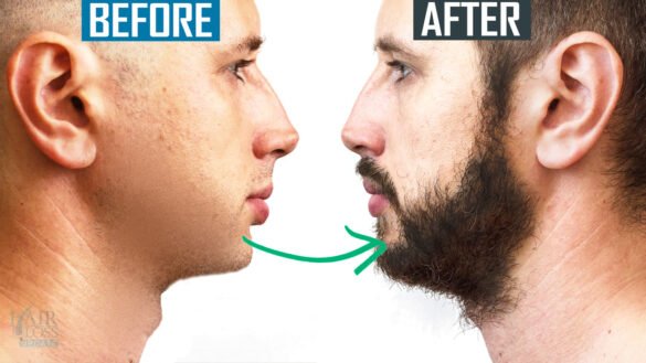 HOW TO GROW A BEARD FAST